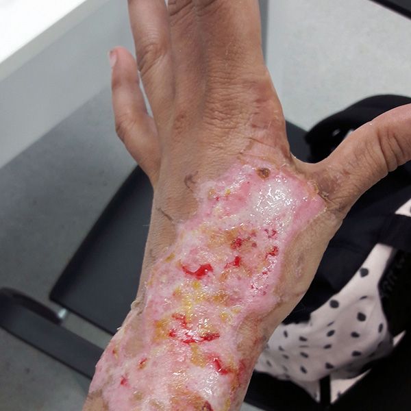 Fisioterapia de quemados